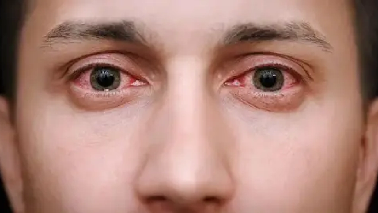 keratitis-shafafoptic.com