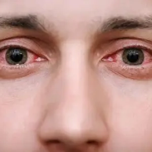 keratitis-shafafoptic.com
