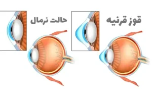 قوز قرنیه باعث کوری می‌شود 