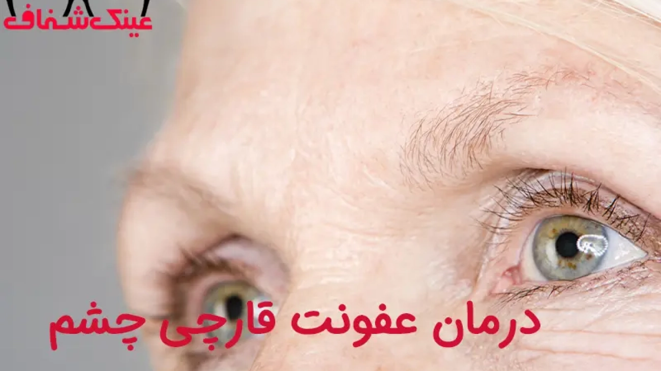 درمان عفونت قارچی چشم