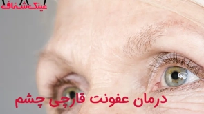 درمان عفونت قارچی چشم