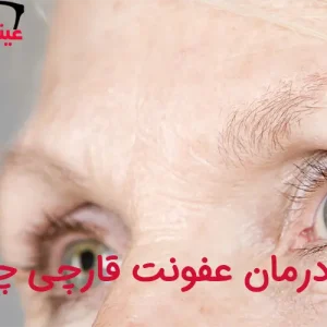 درمان عفونت قارچی چشم