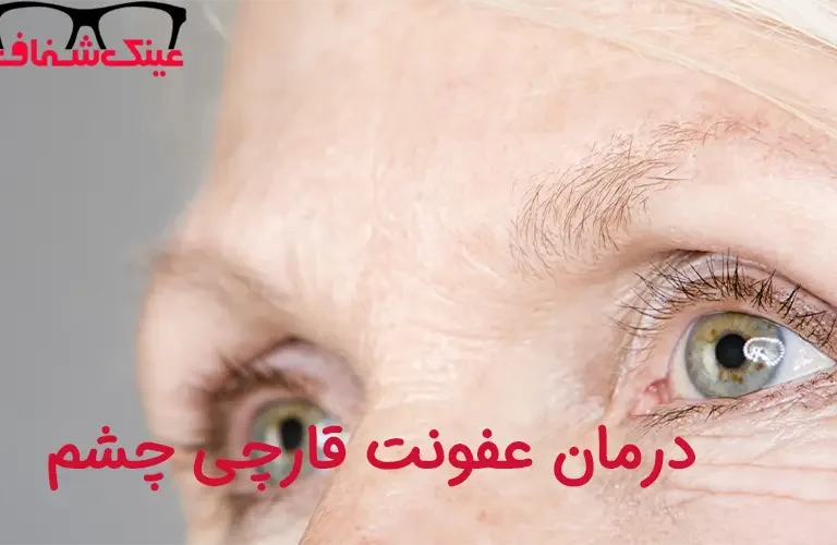 درمان عفونت قارچی چشم